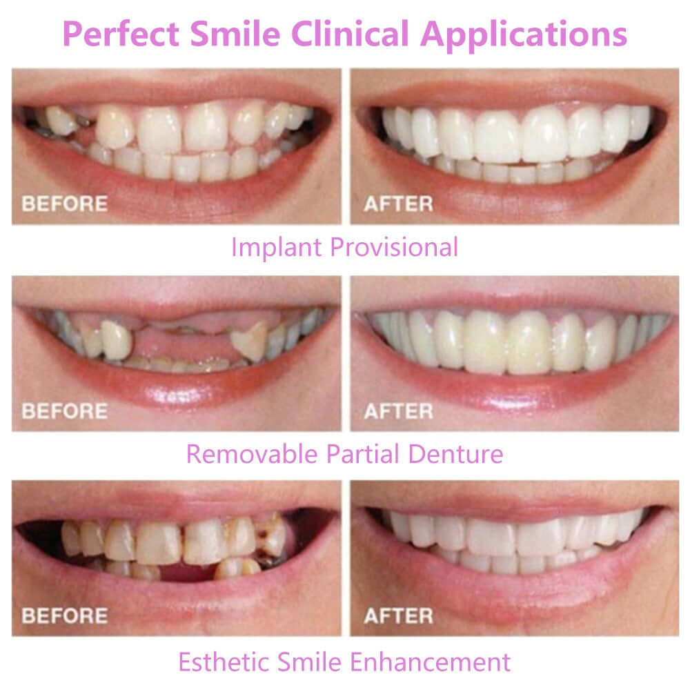 Simulation braces smile whitening